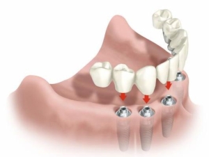implant dentar 08